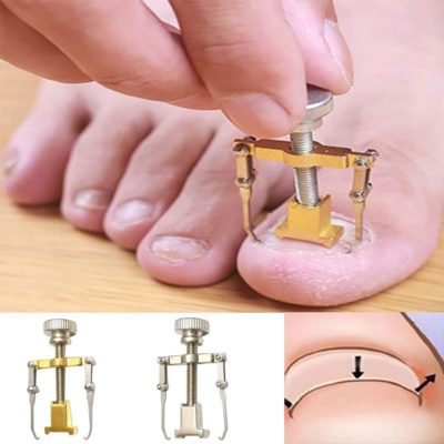 Ingrown Toenail Toe Fixer Recover Correction Device Pedicure Foot Nail Care Tool Easy to Use Beauty-Health Parallax Shop
